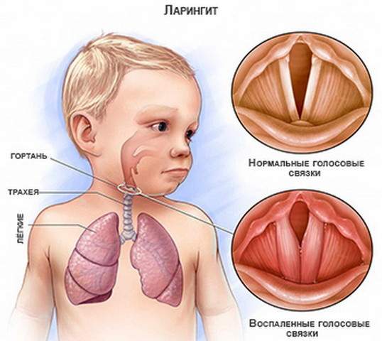 снять отек гортани при ларинготрахеите у детей