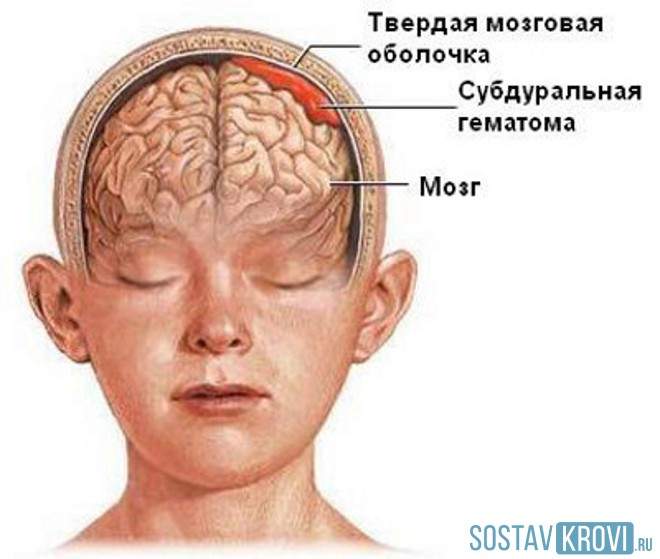 ушиб головного мозга 1 степени что это