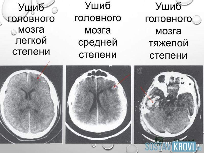 ушиб головного мозга 1 степени что это