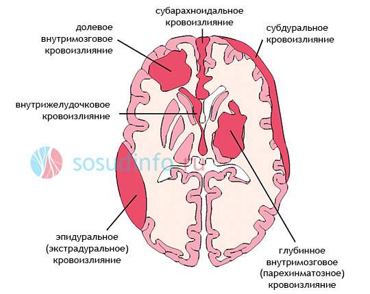 ушиб головного мозга со сдавлением острой субдуральной гематомой