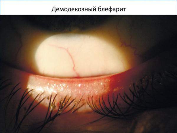 воспаление и отек верхнего века глаза лечение