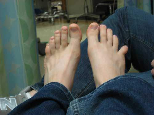 вывих пальца на ноге симптомы и лечение