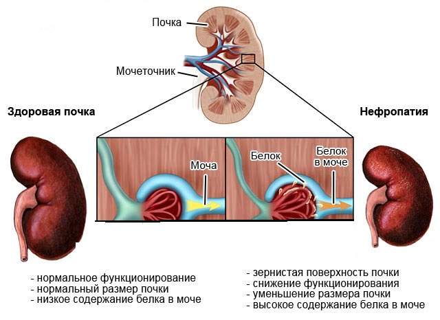 белок в моче без отеков и давления при беременности