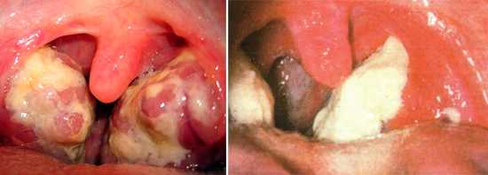 отек подкожной клетчатки шеи при наличии тонзиллита встречается при
