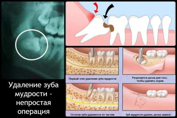 отек после удаления зуба мудрости сколько по времени держится