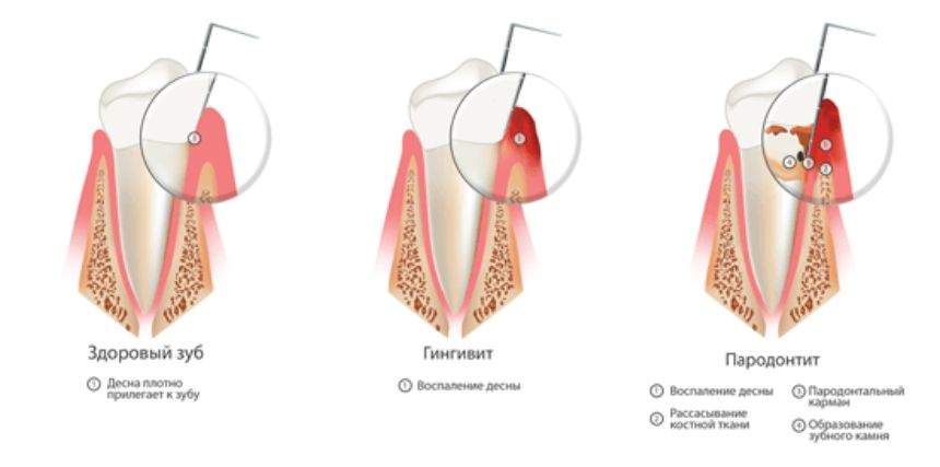 отекла десна вокруг зуба что делать в домашних условиях