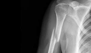 перелом плечевой кости руки лечение срок срастания