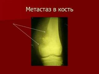 перелом шейки бедра при метастазах в кости