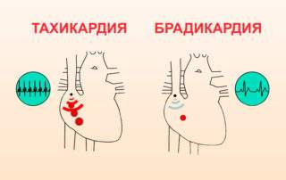 перелом шейки бедра при метастазах в кости