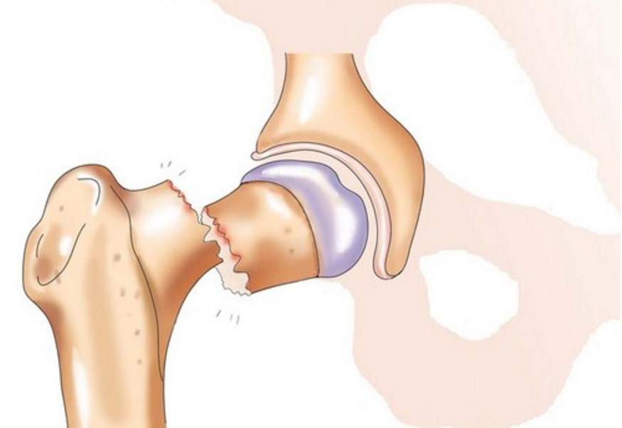 перелом шейки бедра сколько лежать в больнице