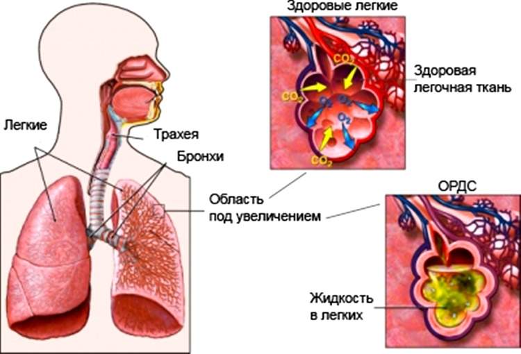 при альвеолярном отеке легких отмечается кашель с выделением мокроты