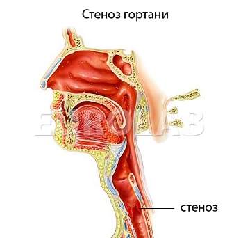 при аллергическом отеке гортани стенозе ii стадии целесообразно проведение