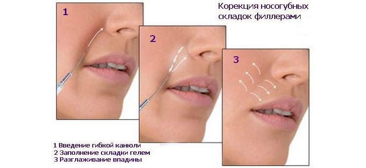 сколько держится отек после введения филлера в носогубные складки