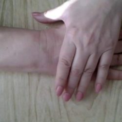 Чем лечить перелом руки после снятия гипса
