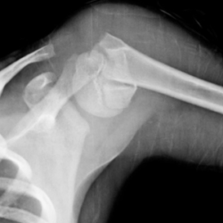 Сколько раз можно делать рентген при переломе