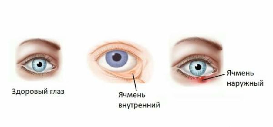 Ячмень на глазу отек под глазом на второй день