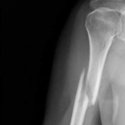 Переломы нижнего конца плечевой кости у детей