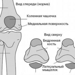 Перелом головки малой берцовой кости без смещения