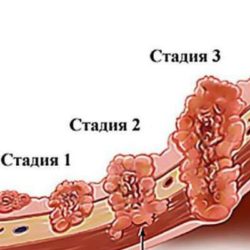 Отеки при раке желудка 4 степени с метастазами