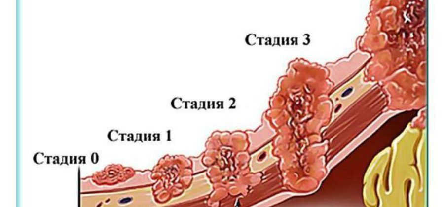 Отеки при раке желудка 4 степени с метастазами