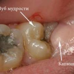 Отек десны возле зуба мудрости что делать в домашних условиях