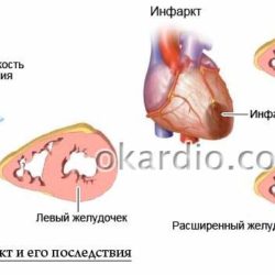 Обширный инфаркт с отеком легких последствия шансы выжить