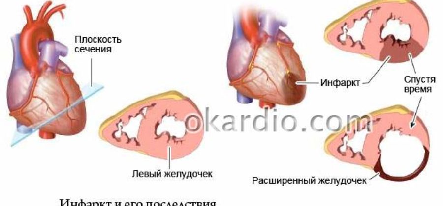 Обширный инфаркт с отеком легких последствия шансы выжить