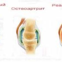 Как снять отек и боль в суставе руки?