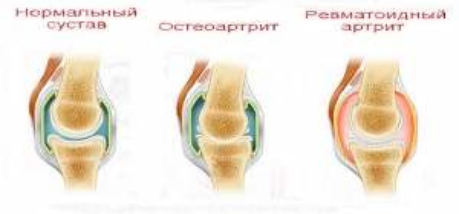 Как снять отек и боль в суставе руки?