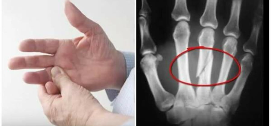 Как сделать перелом пальца руки без боли?