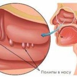 Отек носоглотки без насморка лечение народными средствами