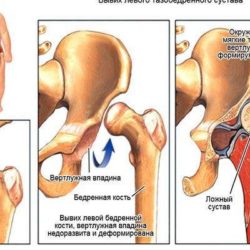 Вывих тазобедренного сустава у взрослых симптомы и лечение