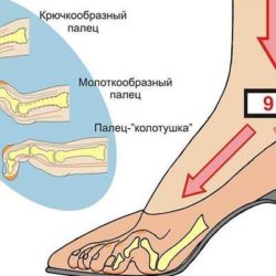 Ампутировали палец на ноге теперь отек ступни что делать