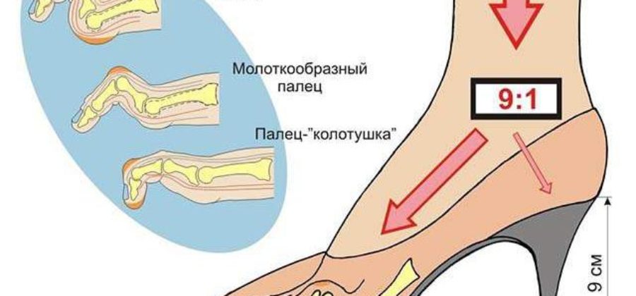 Ампутировали палец на ноге теперь отек ступни что делать