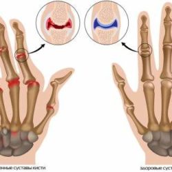 Как снять отек с пальцев рук при ревматоидном артрите?