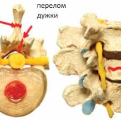Перелом отростка позвоночника в поясничном отделе последствия