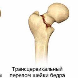 Шейка бедра где находится фото. Классификация Pauwels переломы шейки бедра. Перелом шейки бедренной кости мкб. Классификация переломов шейки бедренной кости Pauwels. Перелом шейки бедренной кости мкб 10.