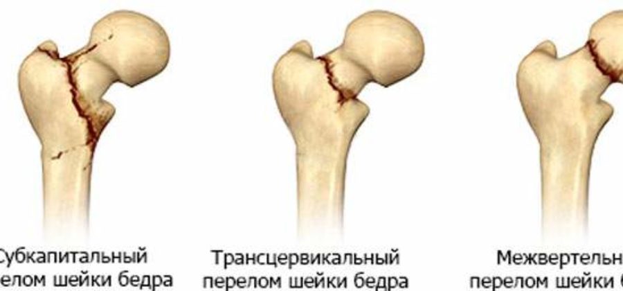 Перелом шейки бедра в возрасте. Классификация Pauwels переломы шейки бедра. Базисцервикальный перелом шейки бедра. Медиальный перелом шейки бедра (внутрисуставной). Закрытый перелом шейки бедра клинические рекомендации.