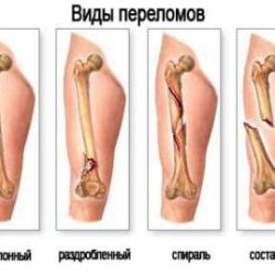 После перелома рука не срастается что делать