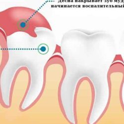 Лезет зуб мудрости опухла щека как снять отек