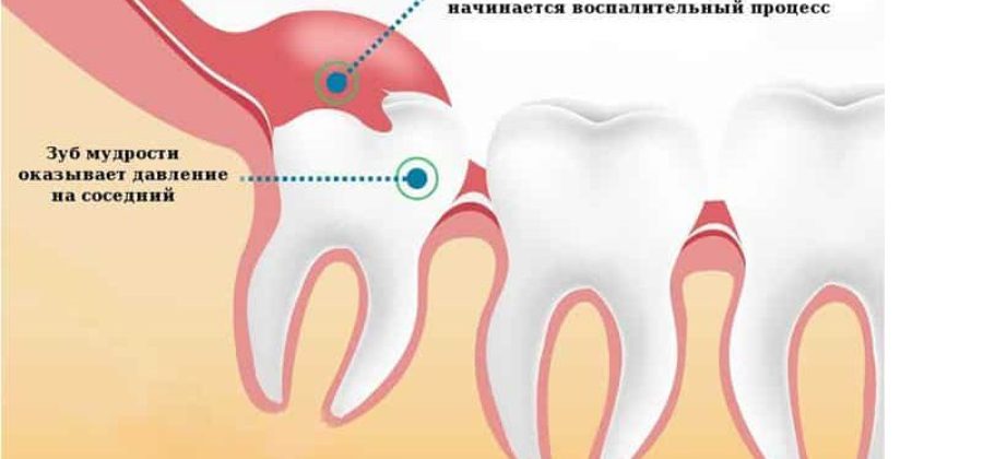 Лезет зуб мудрости опухла щека как снять отек