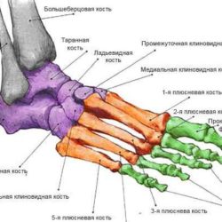 Почему не срастается перелом 5 плюсневой кости?