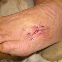 Чем лечить свищ на ноге после перелома
