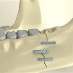 Сколько стоит шинирование при переломе нижней челюсти