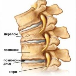 Упражнения после компрессионного перелома позвоночника грудного отдела