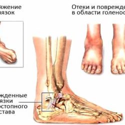 Растяжение связок на голеностопном суставе месяц не проходит отек