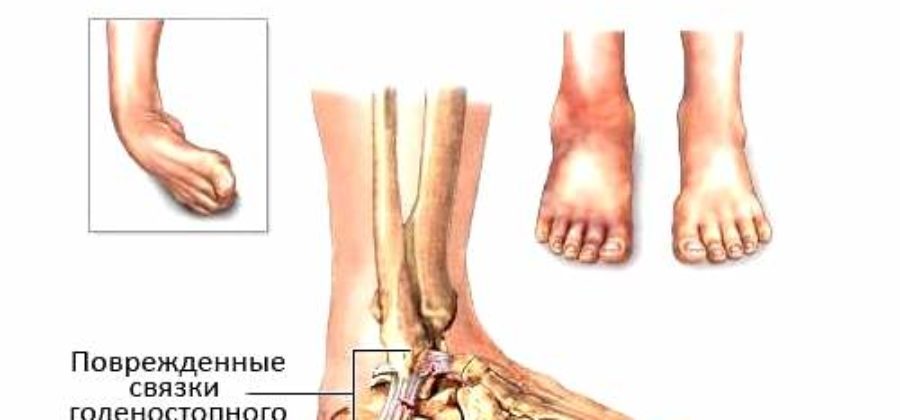 Растяжение связок на голеностопном суставе месяц не проходит отек