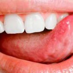 Отек языка с отпечатками зубов на боковых поверхностях языка