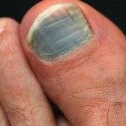 Черный ноготь на большом пальце ноги после ушиба