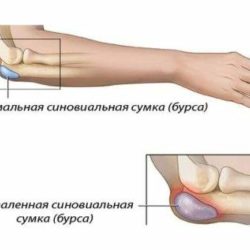 Жидкость в локтевом суставе после ушиба лечение народными средствами